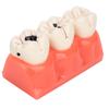 Modelo de Caries Dental Modelo de Demostración de Decaimiento Dental Modelo de Dientes Desmontable de Simulación