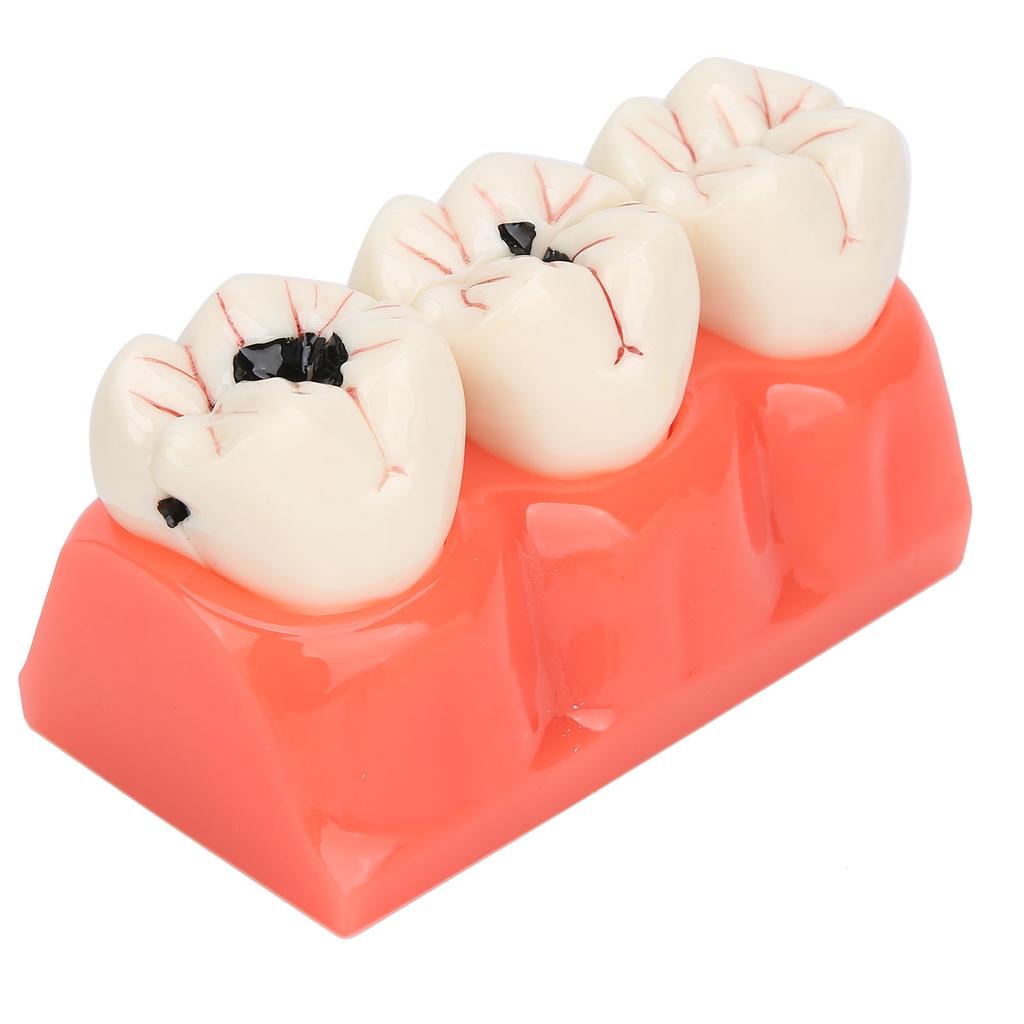 Modelo de Caries Dental Modelo de Demostración de Decaimiento Dental Modelo de Dientes Desmontable de Simulación