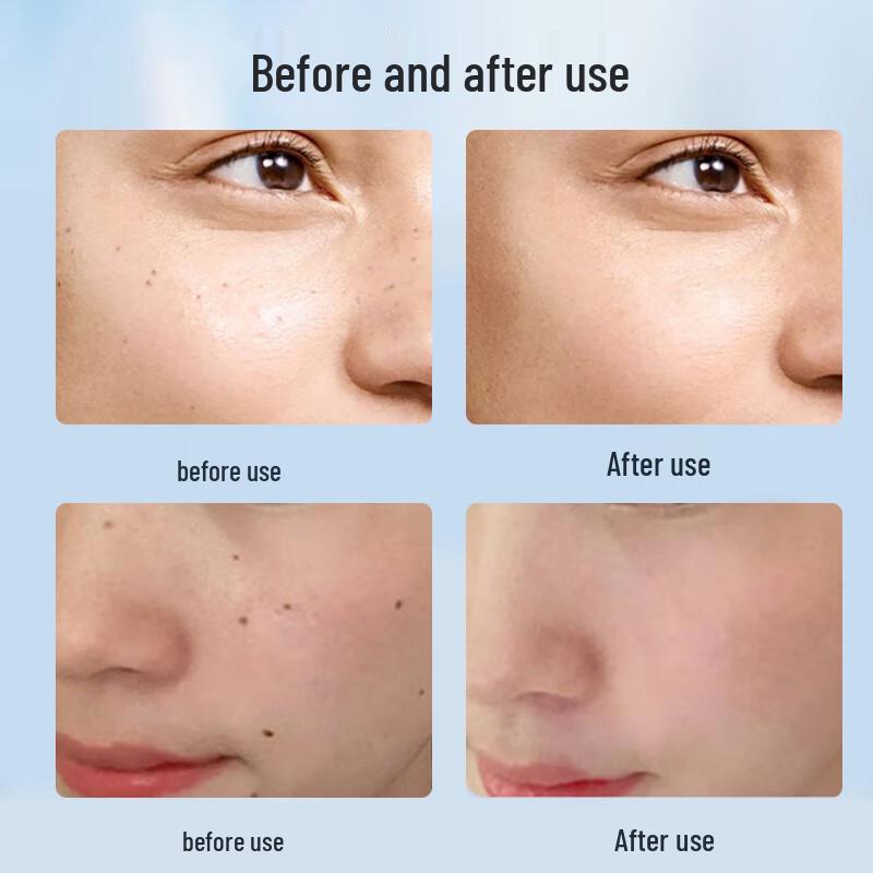 Portable Laser Picosecond Pigment Removal Pen