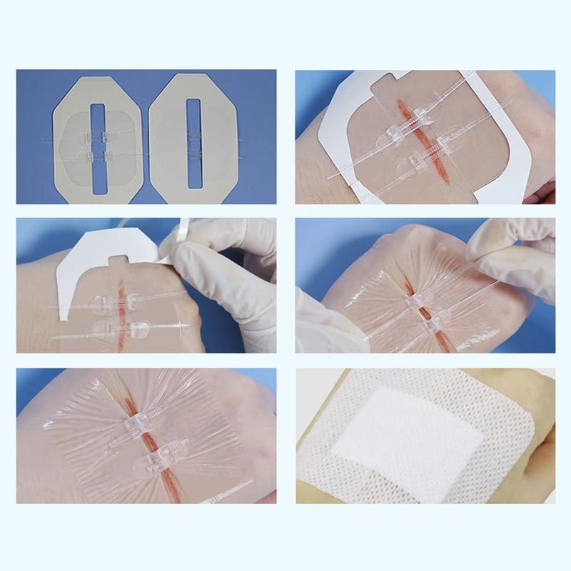 1/2Pcs Zipper Tie Wound Closure Patch Hemostatic Patch Wound Fast Suture Zipper Band-Aid Outdoor Portable