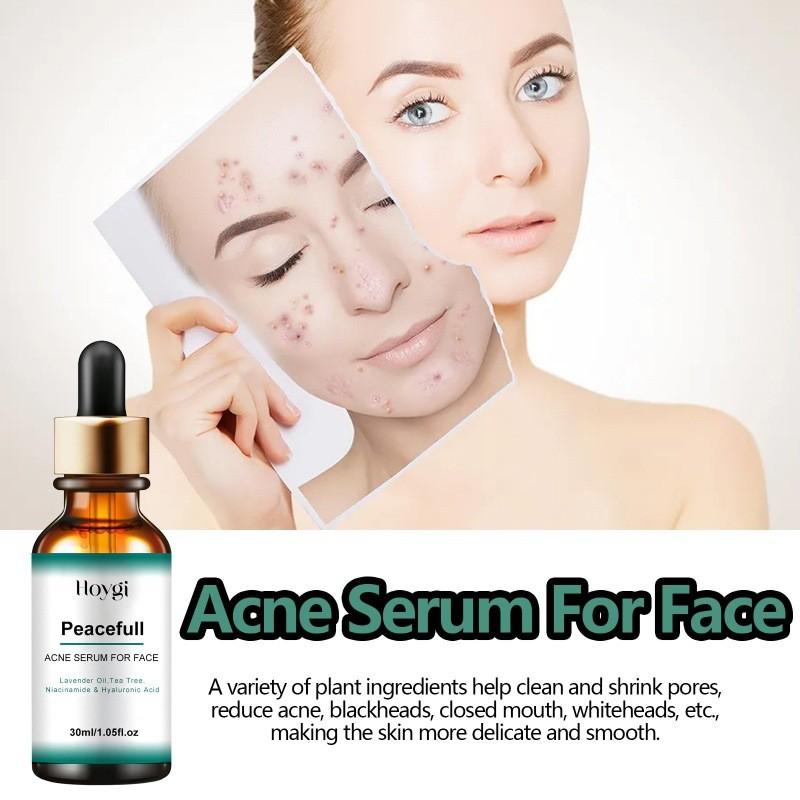 Hoygi Acne Essence With Hydrating Properties For Reducing Blemishes And Pore Refinement