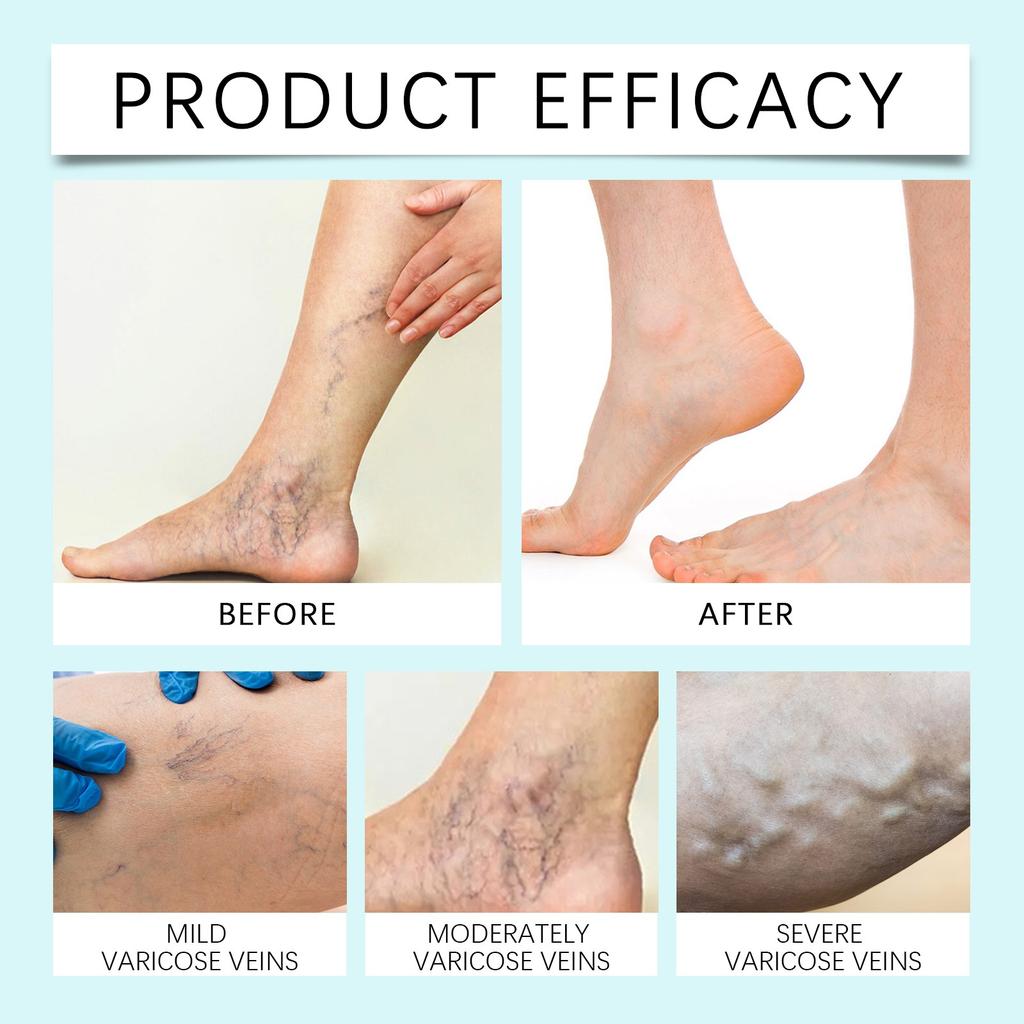 Varicream With Horse Chestnut Extract And Buckwheat , For Daily Care Of Tired And Heavy Legs