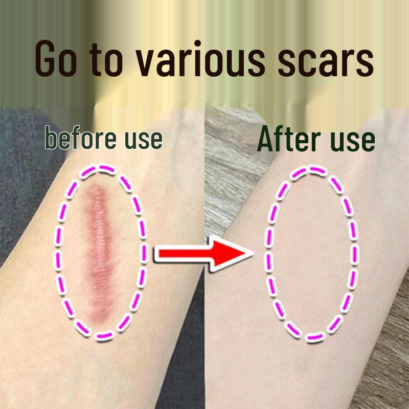 

Крем для відновлення шкіри від акне та шрамів: Освітлення шрамів, загоєння опіків, зменшення гіпертрофічних та післяопераційних шрамів 100g