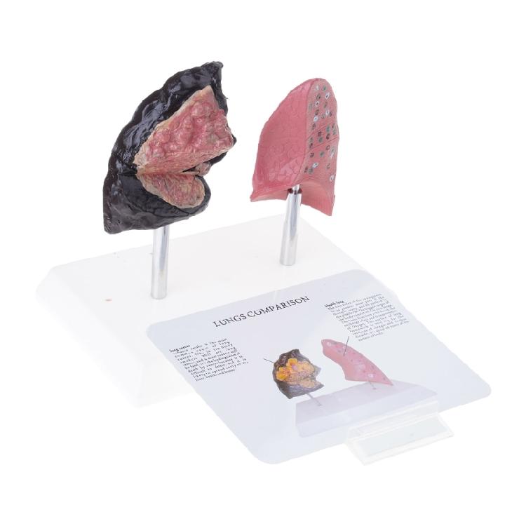 Anatomically Accurate Smoker Lung Comparison Model With Healthy Lung PVC Substance For Clinical Education