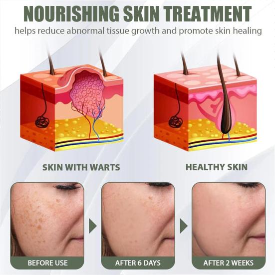 Instant Mole Spot Removal Gel Corrector Cream for All Skin Types Natural Extracts 50g Hydrating Gel Dark Spot Remover