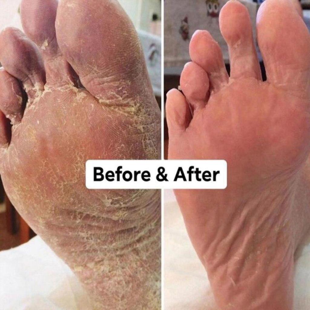 Chapped Hands and Feet Repair Cream, Moisturize, Nourish the Skin, and Leave the Skin Soft and Delicate