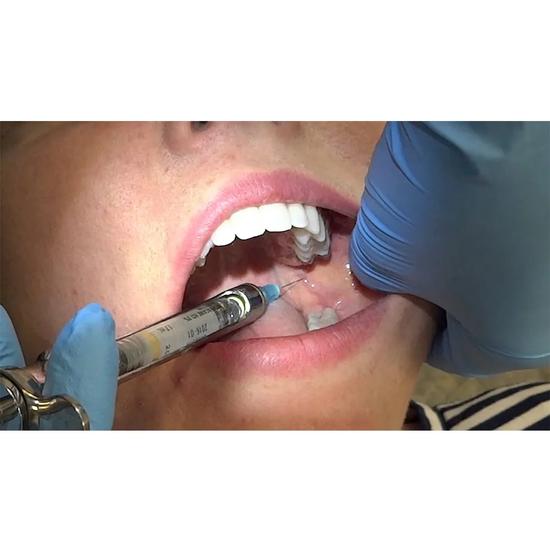 GDC Dental Syringe Aspirating With Ring (1.8ml) (SYRA1.8)