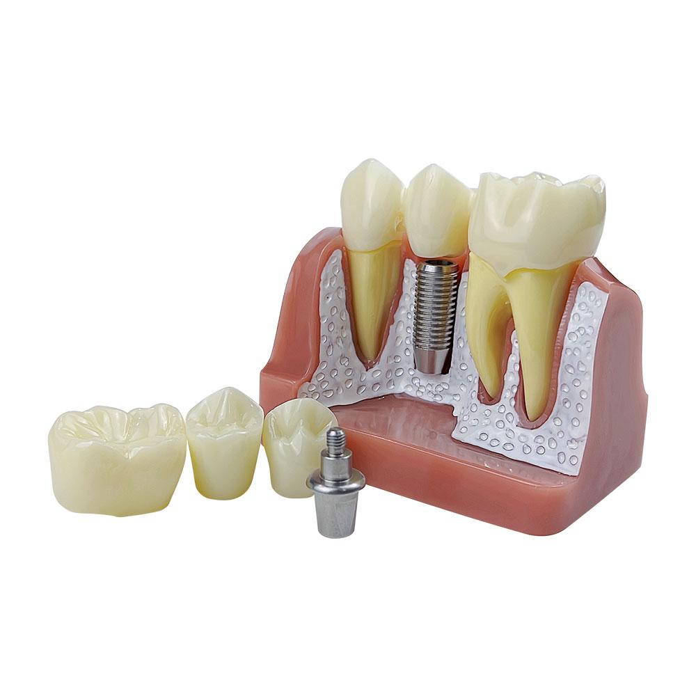 Modello Dimostrativo di Impianti Dentali 4 Volte Denti Analisi Impianti Corona Ponte Modello Rimovibile Per Studenti Dentisti Insegnamento Studio