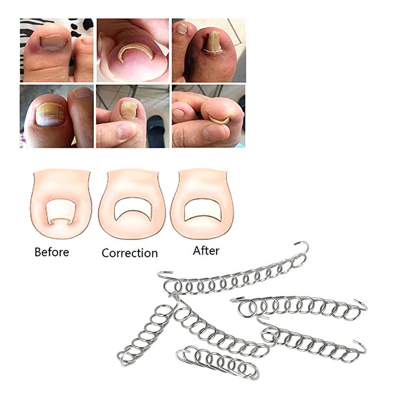 Ingrown Toe Nail Correction Wire Fixer Pedicure Paronychia Recover Toenails Corrector With Toe Correction Files Foot Care Tool