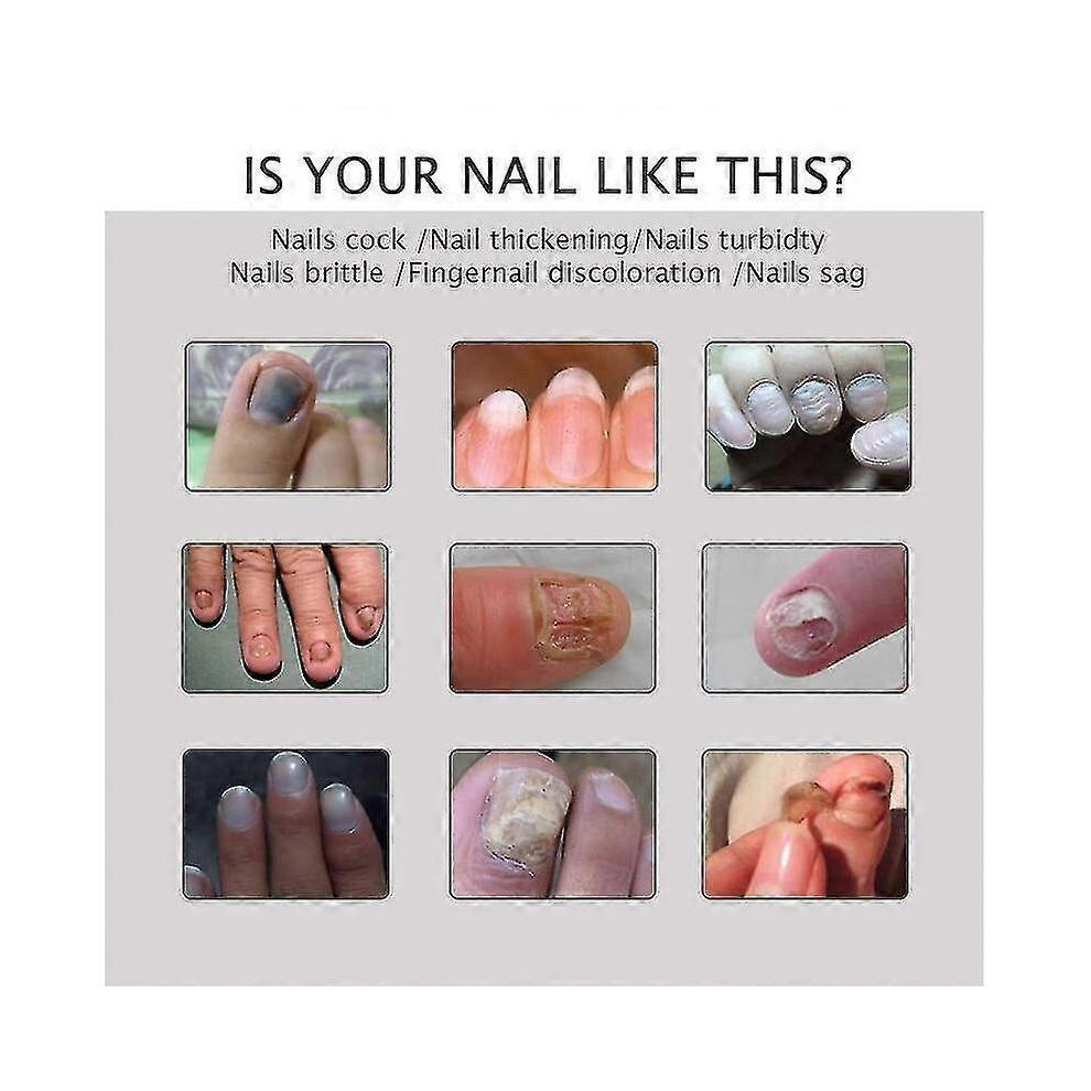 3x Efero Nagelpeeling Pflanzen-Nagelreparatur-Flüssigkeit Nagelcreme Nagelpflege-Gel Nagelreparatur-Gel Feuchtigkeitsspendender Nagelglanz Tw