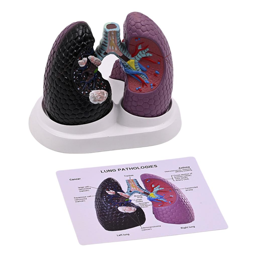 Anatomical Pathological Lung Model Human Lung Anatomy Model Normal and Pathological Lung Anatomy Model for Teaching Tool