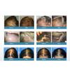 100-240V 50/60Hz Rechargeable Laser Hair Regrowth Helmet 678nm Hair Low Light Extension Laser Cap Treating Hair Loss