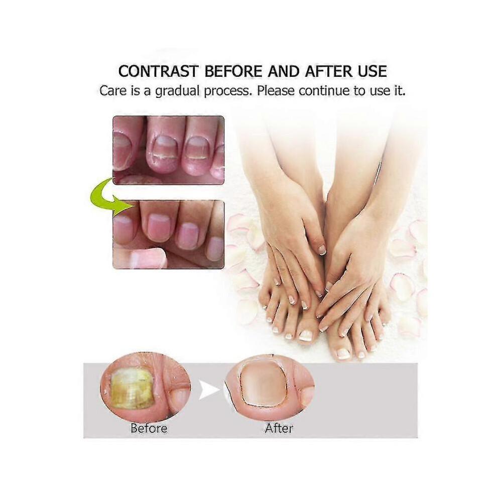 3x Efero Nagelpeeling Pflanzen-Nagelreparatur-Flüssigkeit Nagelcreme Nagelpflege-Gel Nagelreparatur-Gel Feuchtigkeitsspendender Nagelglanz Tw