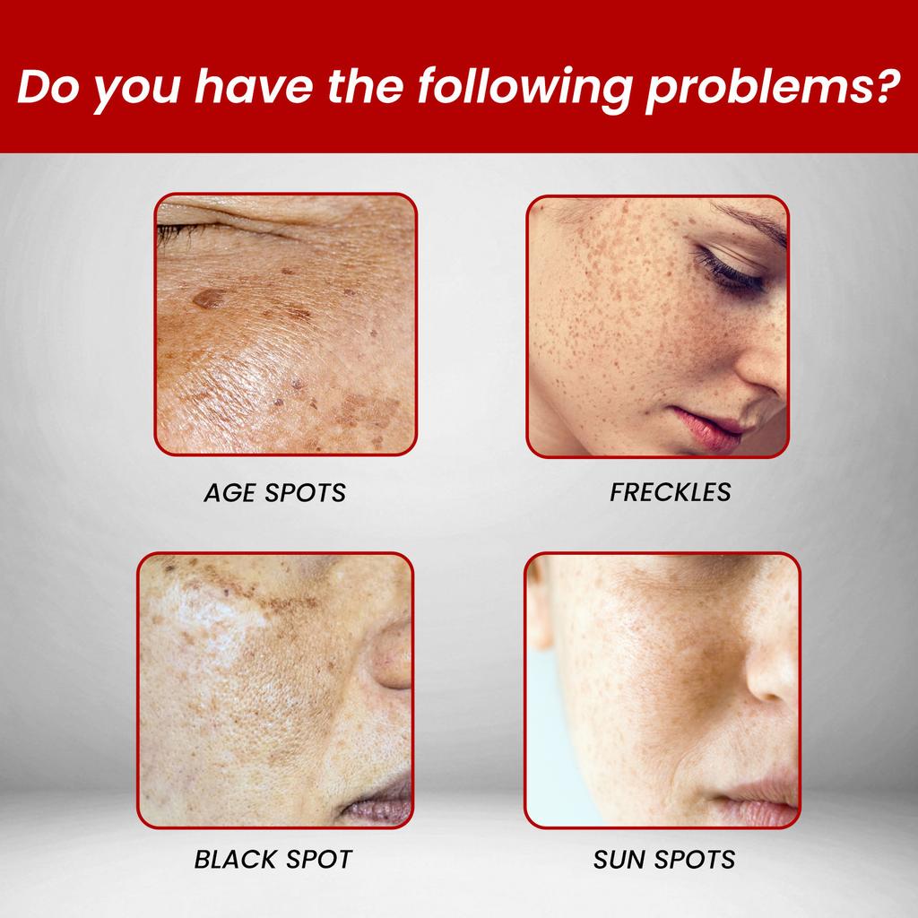 Black Spot Removal Cream, Moisturizing And Repairing, Fading Facial Fine Lines And Spots, Melanin Hydrating And Whitening Skin