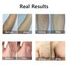 HOMZY Portable IPL Laser Epilator 999999 Flashes - Painless, Permanent Hair Removal for Women’s Body and Bikini Line