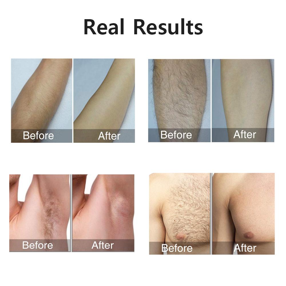 HOMZY Portable IPL Laser Epilator 999999 Flashes - Painless, Permanent Hair Removal for Women’s Body and Bikini Line