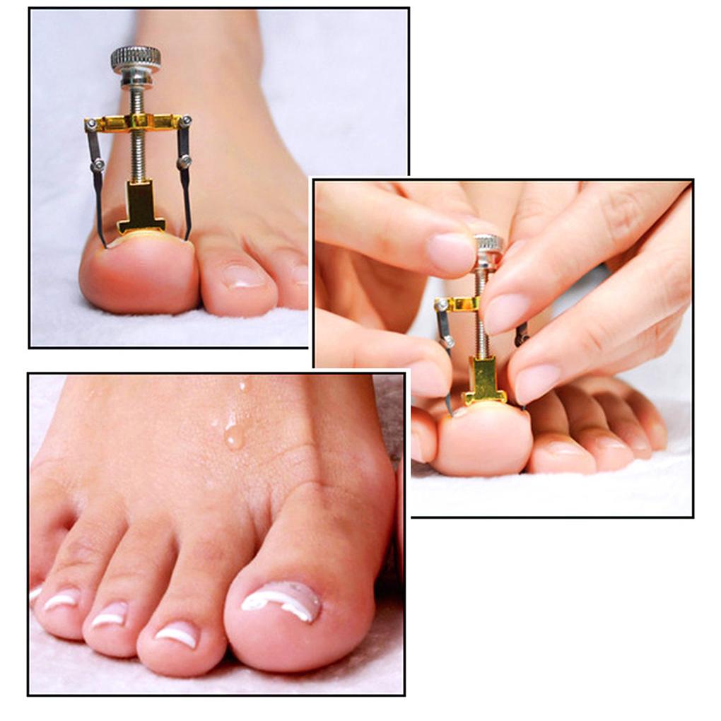 Nail Corrector Toenail Correction Tool Premium Material Ingrown Wire Fixer Stainless Steel Antislip Handle Foot Care Tools
