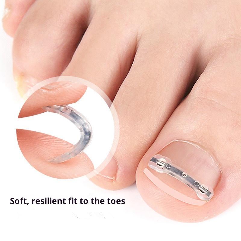 Ingrown Toenail Corrector Tools Pedicure Recover Embed Toe Nail Treatment Professional Ingrown Toenail Straightening Clip Brace