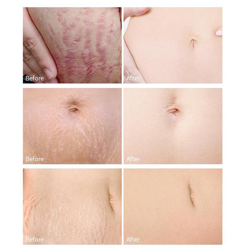 Smoothing Skin Stretch Mark Cream, Gentle and Non-irritating, Smooths Wrinkles and Fades Fine Lines