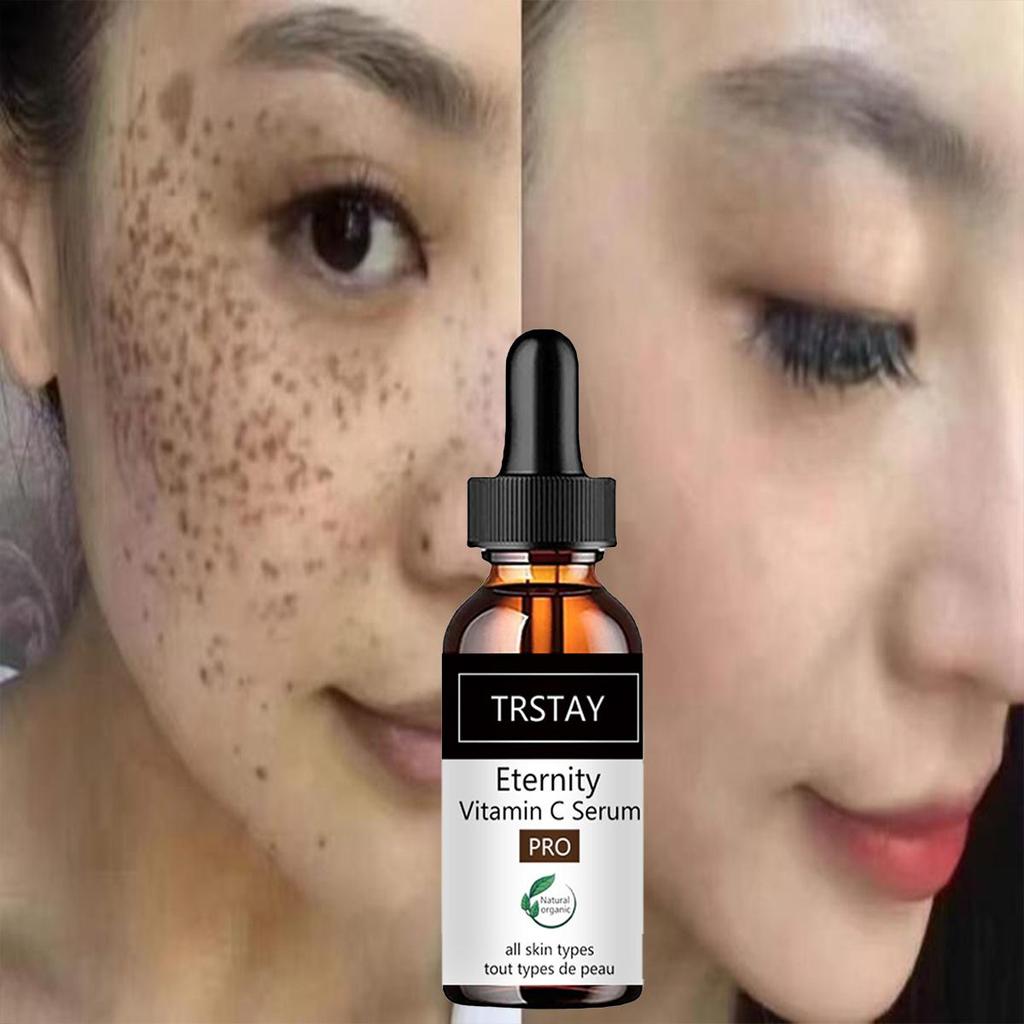 Removing Dark Spot Whitening Cream, Freckles Face Cream, Remove Melasma Remove Dark Spots Cream, Lightening Remover Brightening
