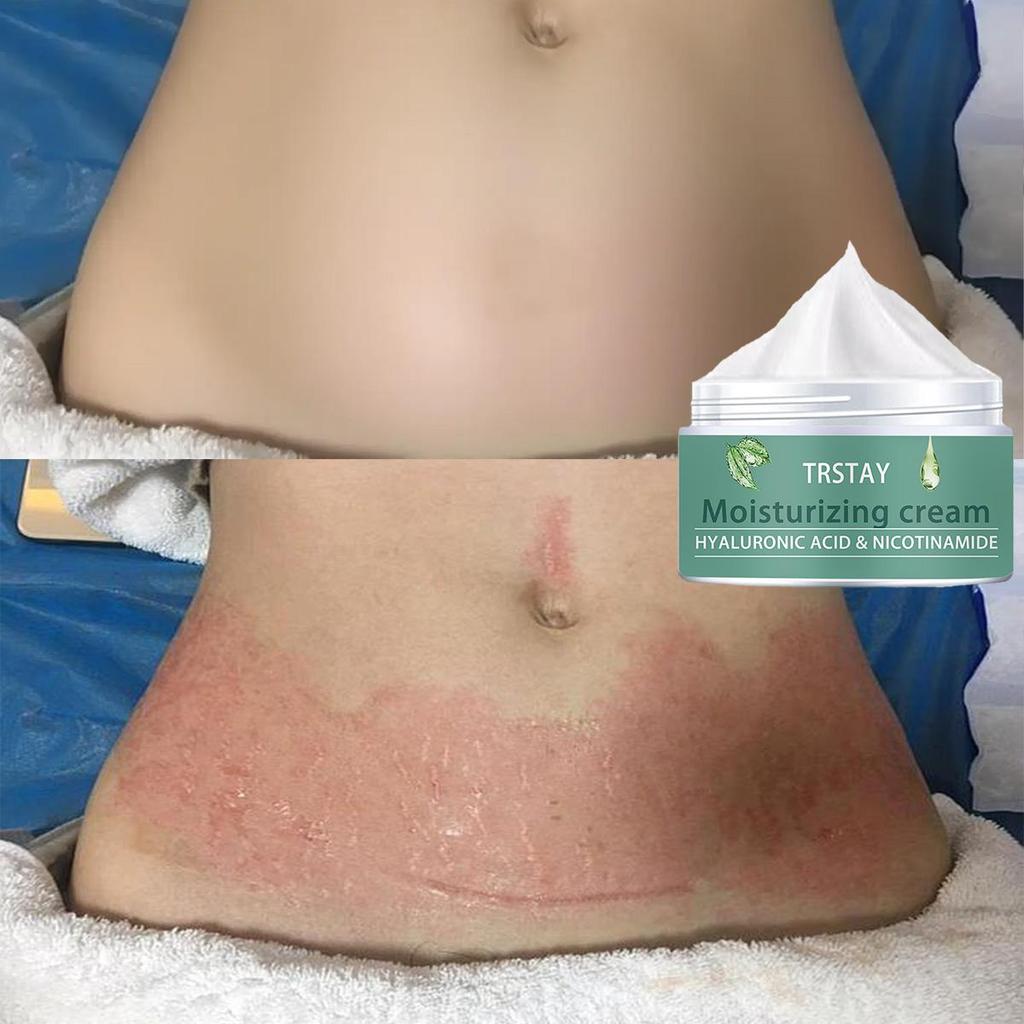 Těhotná žena strie Repair Cream Poporodní opravy a vyblednutí strií