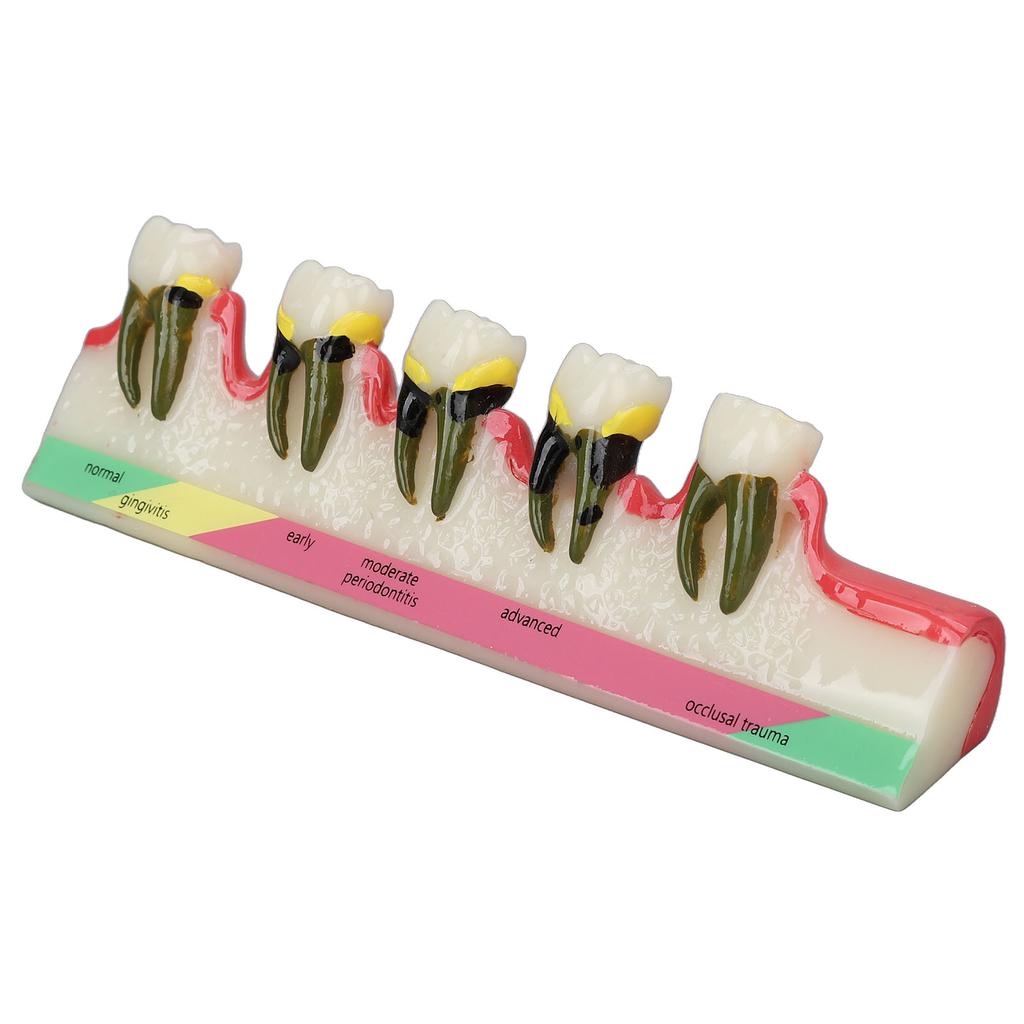 Dental Teeth Model Ceramic Clear Structure Oral Care Educational Periodontal Disease Model