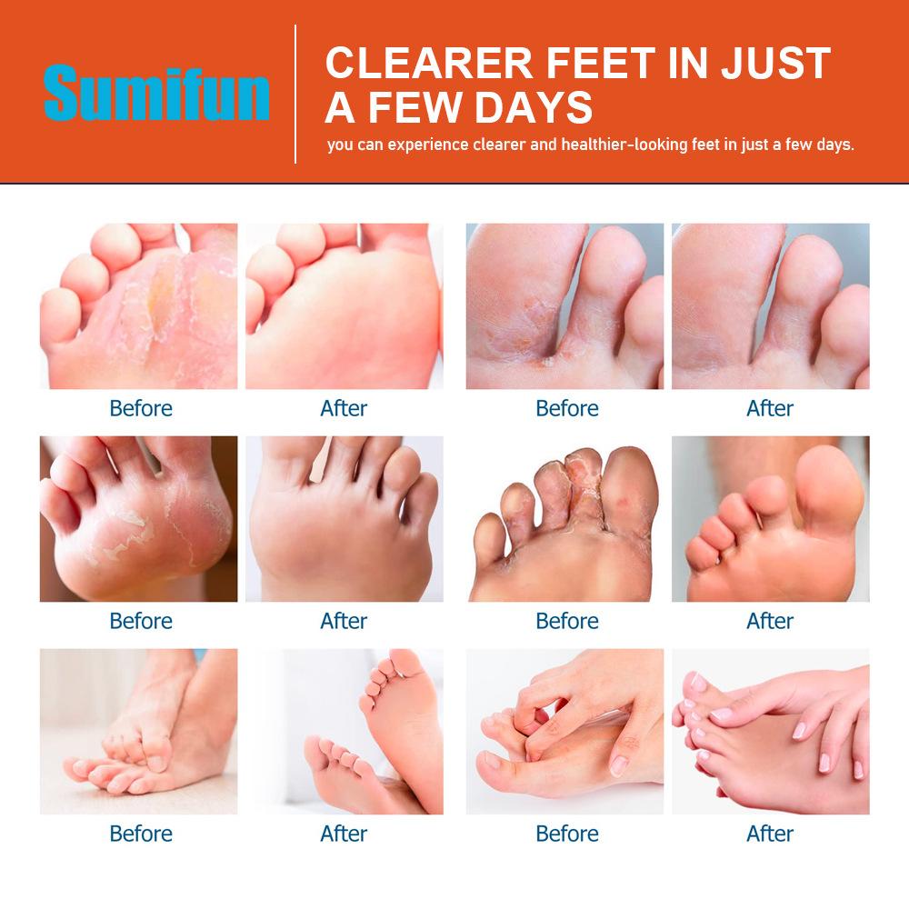 Sumifun 30/60/150ML Relieve Foot Odor Spray Foot Sweating Toe Anti-Itching Summer Essential Exercise Foot Care Bacteriostat Liquid Spray