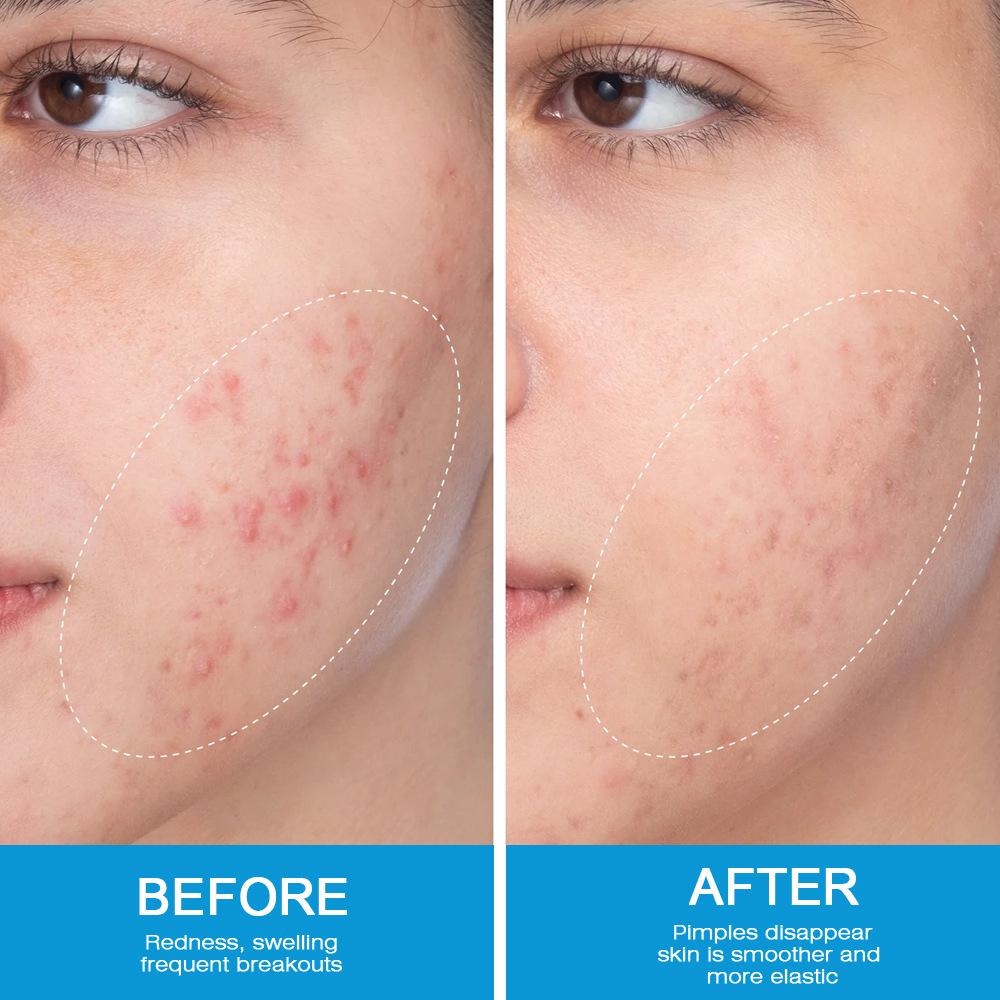 Sumifun Освітлюючий крем від шрамів від вугрової висипки, темних крапок і плям 20 г