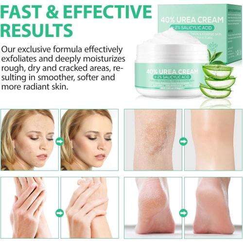 Urea Cream, Hand and Foot Hydration, 40% Urea Cream for Dry, Cracked Feet, Heels, Knees, Elbows, and Hands, Moisturizing, Corn Removal, and Calluses,