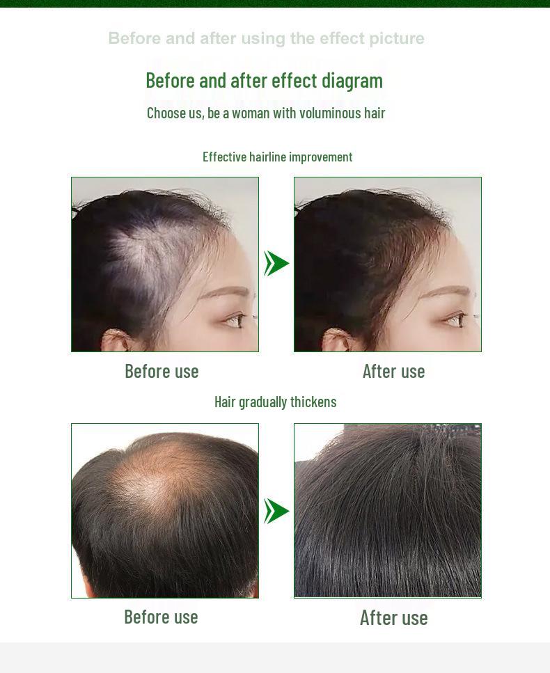 Adjustable Microneedle Roller for Beauty & Hair Growth - DRS140A Stamp, Local Hydration, Needle Length Customization, Hair Regrowth - Model 120A