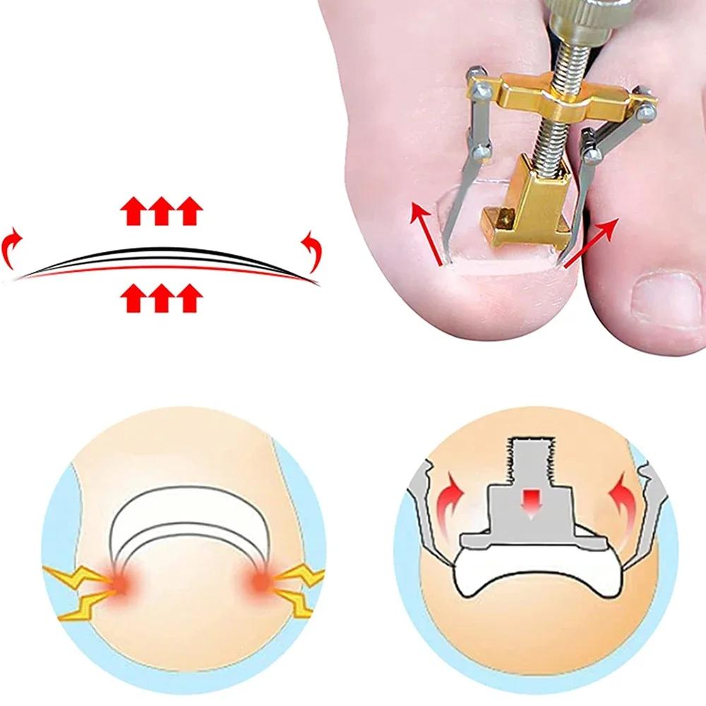 Ingrown Toenail Correction Patch Stickers Ingrown Toenail Treatment Lifter Toe Nail Patch Correction Buckle File Cuticle Pusher