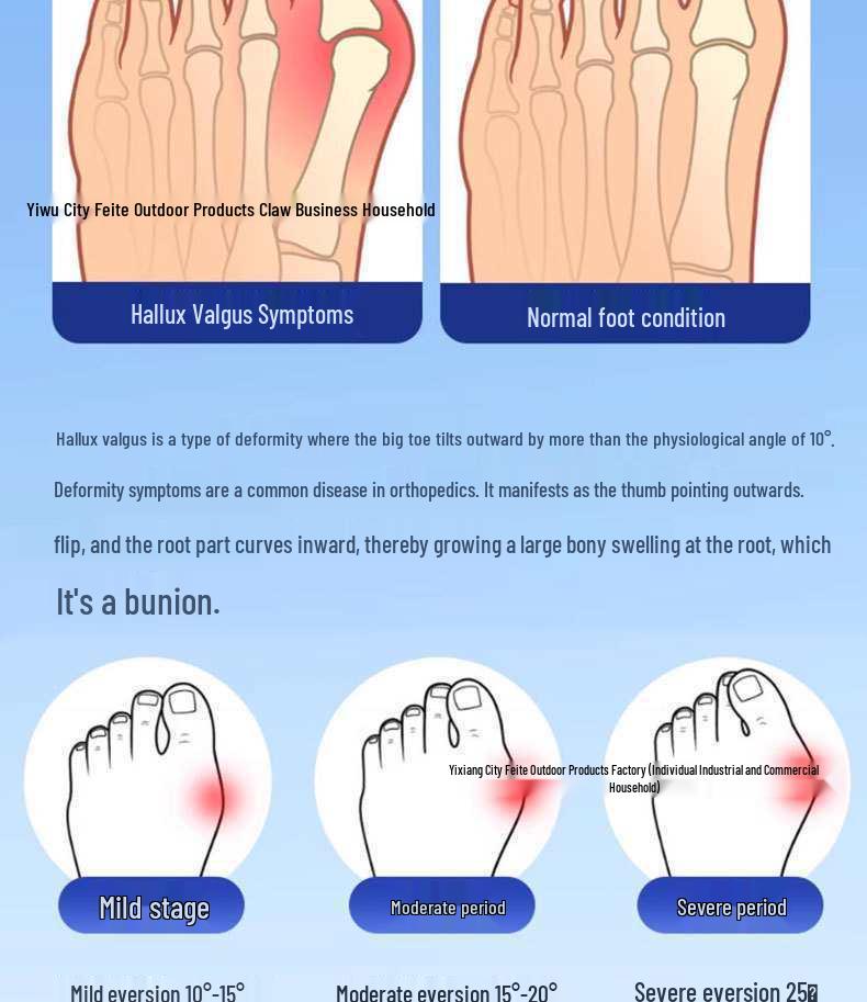 Adjustable Hallux Valgus Corrector for Foot Comfort and Alignment