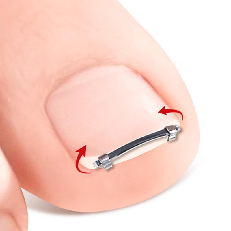 Narzędzie do Pedicure na Wrastające Paznokcie u Stóp Wkładka Pielęgnacja Paznokci u Stóp Prostowanie Korekcyjne Klips Zakrzywiony Zacisk Narzędzie do Korekcji Paznokci u Stóp