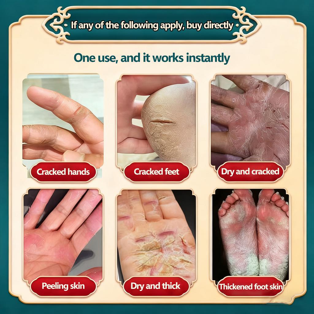 Cremă specială de vindecare pentru mâini și picioare crăpate, piele uscată pe mâini și picioare, prevenirea crăpăturilor degetelor, cremă pentru degerături și crăpături în timpul iernii
