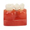 4 Times Dental Implant Model Crown Bridge Implant Teeth Demonstration Model for Doctors Patient Education