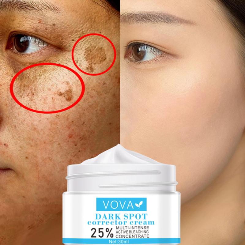 

Whitening Freckle Cream Remove Melasma Acne Spot Pigment Melanin Dark Spots Pigmentation 30g