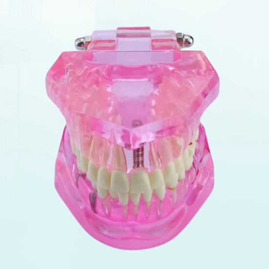 Dental Implant Model Teaching Aid for Dentist Student School Removable Teeth