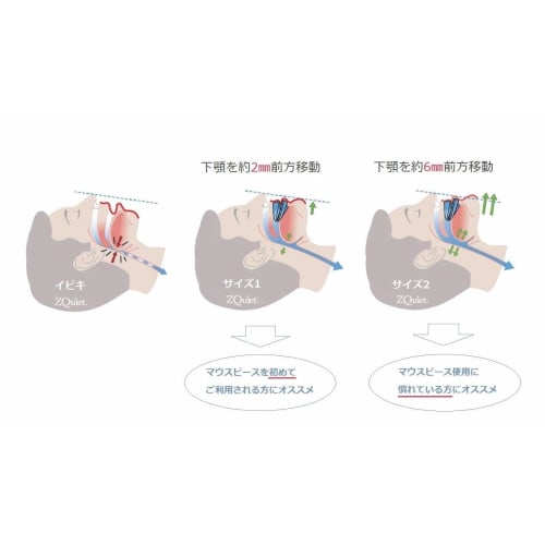 ZQuiet Made In USA Size 1 Jaw Forward Movement 2mm Snoring Mouthpiece with Storage Case, Snoring Relief Aid, Snoring Support (1)