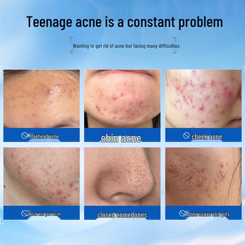BEAUTY NOTES Teen Skincare for Acne & Blemishes