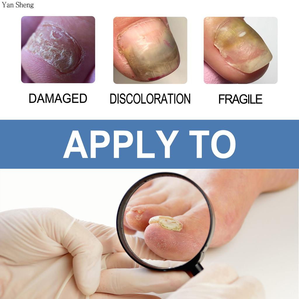 Nail Care Gel Hand Foot Onychomycosis Soft Nail Thickening Nail Luminescent Nail Repair Gel