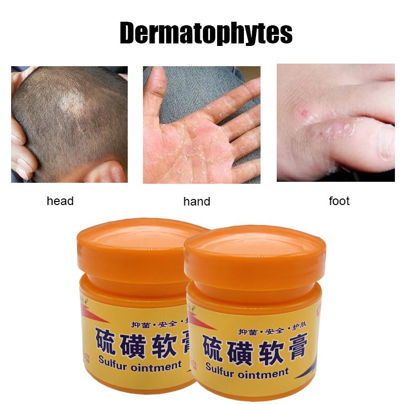 Sulfuric Moss Care Relieves Skin Itching, Redness, And Swelling. Cowhide Moss Moisturizing Skin Care