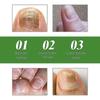 10ML Health Toenail Stick Roller Bead Onychomycosis Care Solution for Women Men
