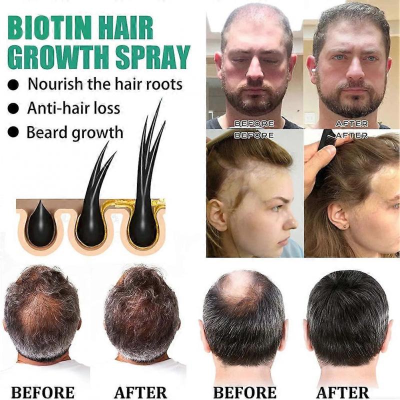 Biotin hair growth spray anti hair loss fast regeneration scalp treatment essence