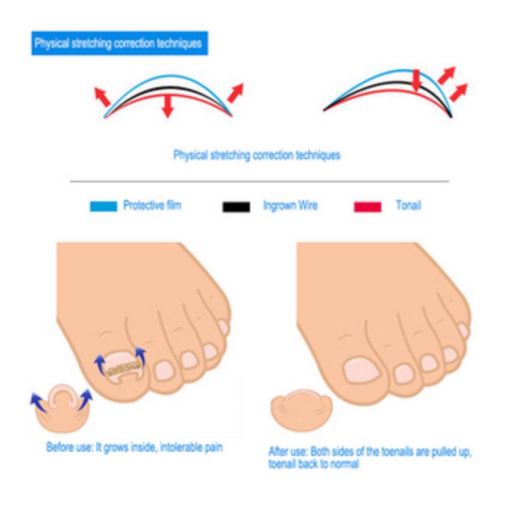 12 Pcs/box Ingrown Toe Nail Correction Pedicure Wire Fixer Paronychia Recover Tool