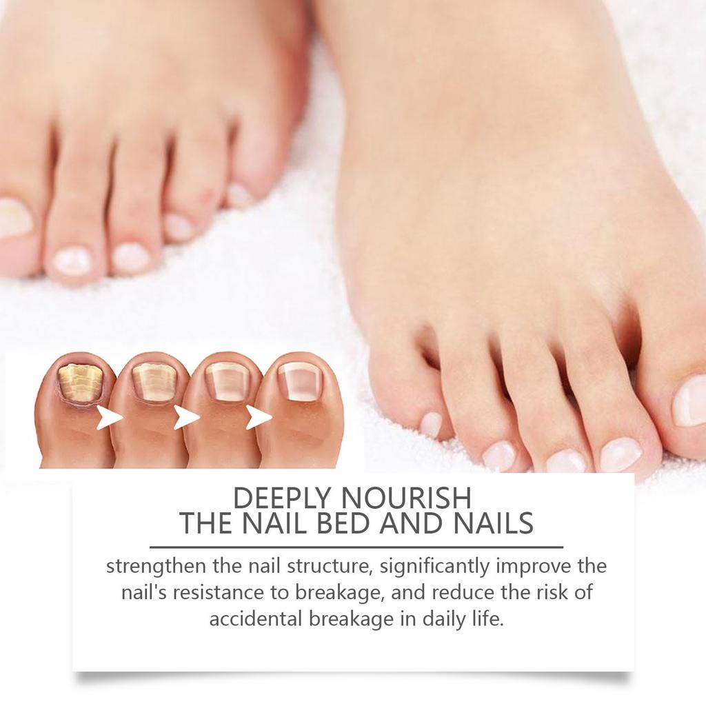 Bee Nail Liquid Special Liquid Nail Care Liquid Soft Nail Paste Nail Care Nail Care Onychomycosis Liquid8ml