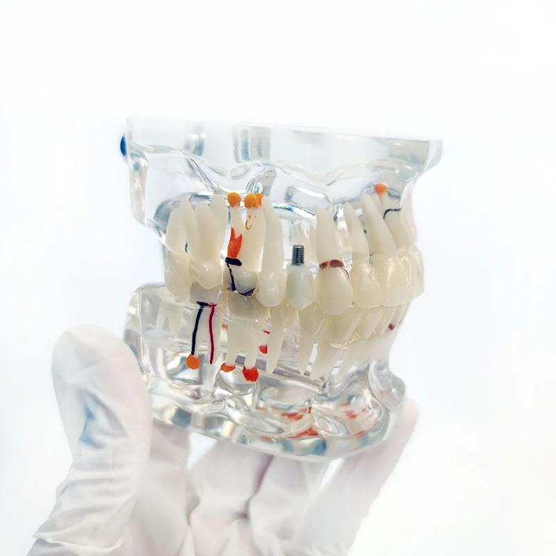 Dental Teaching Model Pathology Model With Half/Full Implant C1/C4 Dentist Laboratory Material Tools