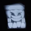 160Pcs Pe Material Forehead Smile Patterns Transparent Skin-Friendly Anti-Wrinkle Sticker Invisible Nasolabial Folding Patches