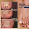 50 Pcs Ingrown Toenails Patch Sticker Toenail Patch Corrector Pedicure Tools Ingrown Toenail