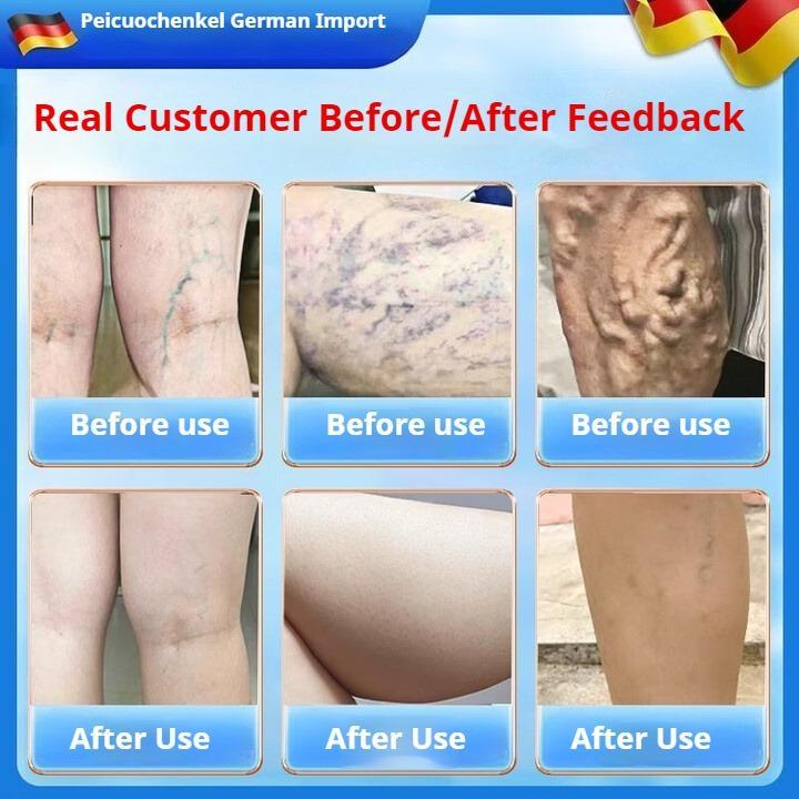 Therapy for Relieving Varicose Vein Symptoms