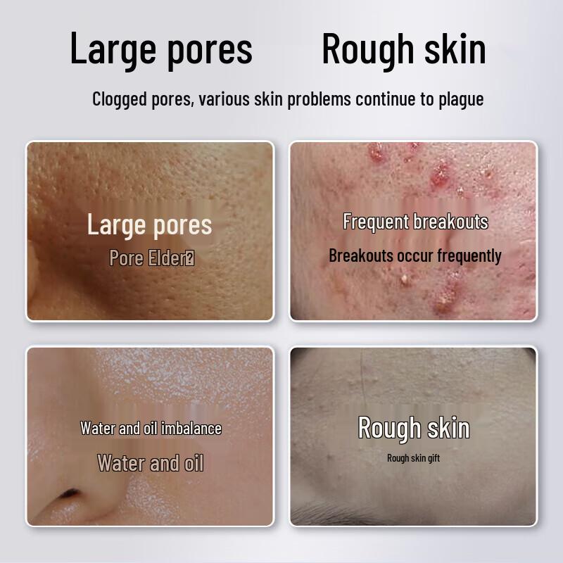 Jiaoboshi Porenverfeinernde & Aknebehandelnde Gesichtsmaske